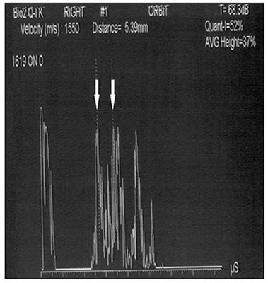 Ultrasound Detection of Intracranial Hypertension in Brain Injuries